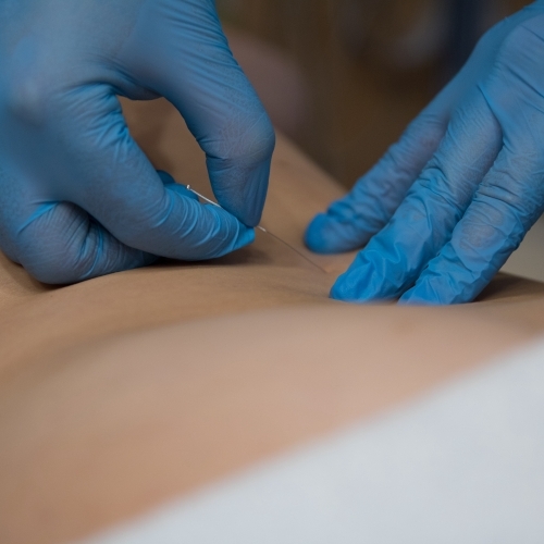 dry-needling-evidence-physical-therapy-glenn-dale-clinton-laurel-md